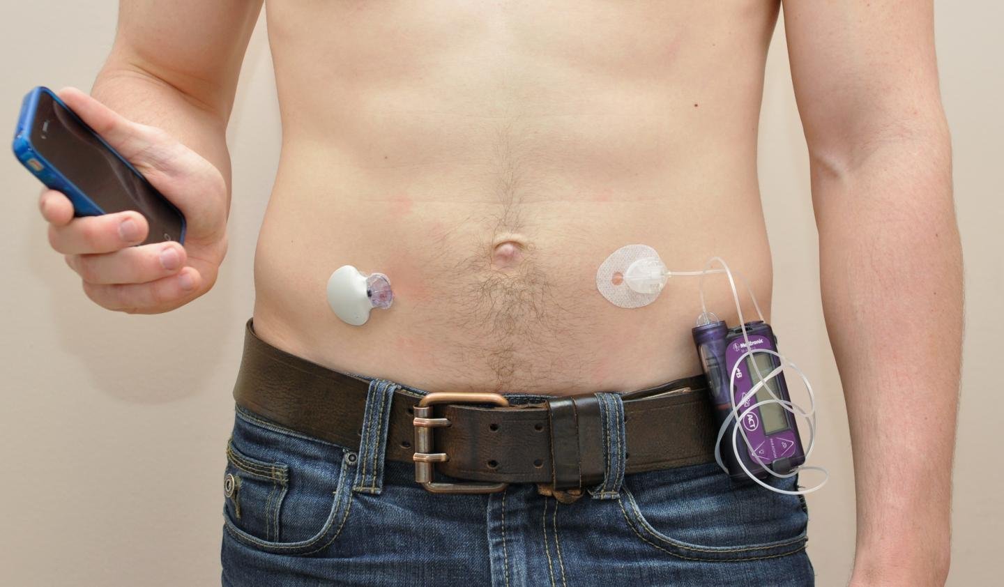 Artificial Pancreas: The Medical Breakthrough Set to Transform Life with Diabetes